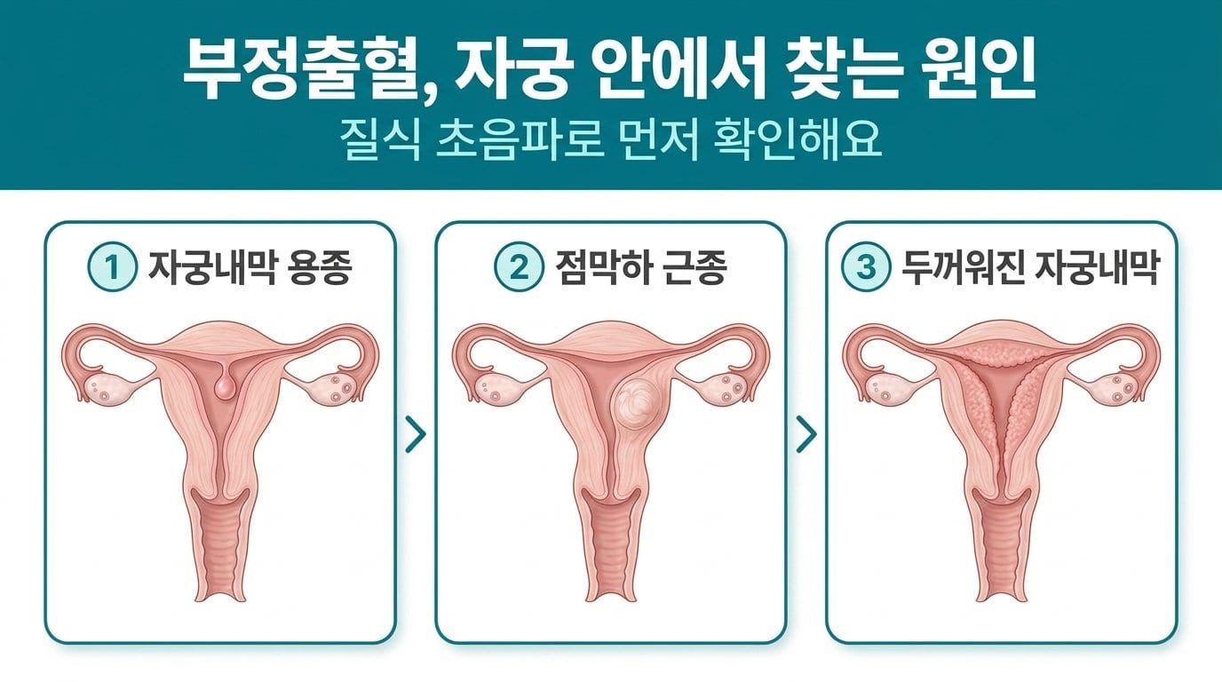 부정출혈을 일으키는 자궁 안의 구조적 원인 — 자궁내막 용종, 점막하 근종, 두꺼워진 자궁내막을 같은 자궁 단면에 비교한 자료화면